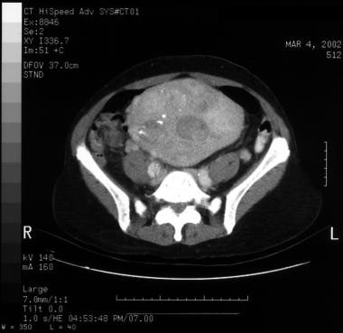 Aortic dissection. CT scan showing a flap. 