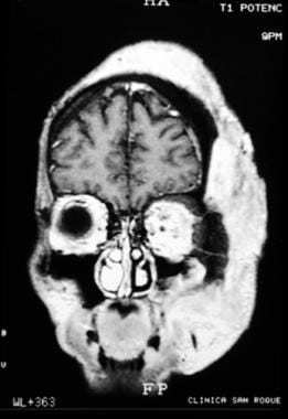 MRI with coronal view of mycetoma in a 47-year-old