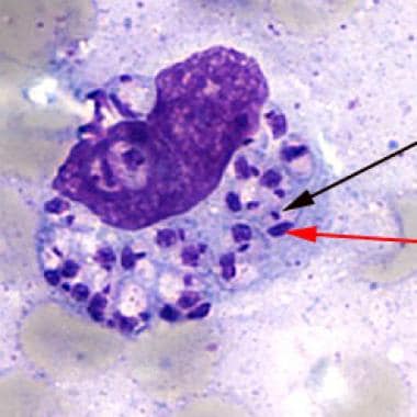 visceral leishmaniasis histology