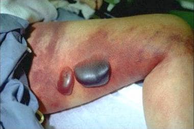 perianal streptococcal dermatitis