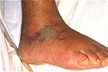 vibrio parahaemolyticus skin infection