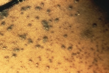 Hemorrhagic-type variola major lesions. Death usua