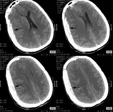 Closed Head Injury Practice Essentials Pathophysiology Epidemiology