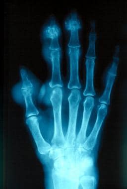 Gout. Plain radiograph showing chronic tophaceous 