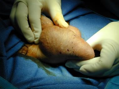 Spermatocele as seen prior to incision. 