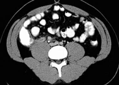 CT scan reveals an enlarged appendix with thickene