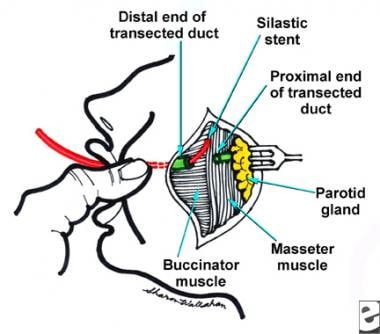 Laceration of the parotid duct over the masseter. 