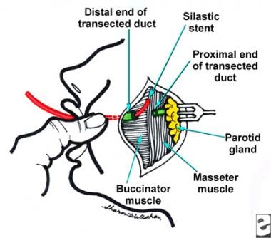 Incision localization and buccal fat pad being removed. Note parotid