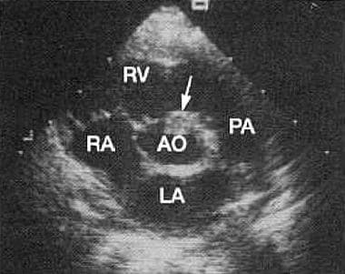 Ventricular Septal Defects. Echocardiogram from a 