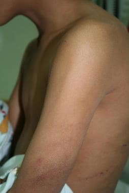 Linear inflicted bruising extending from arm to ba