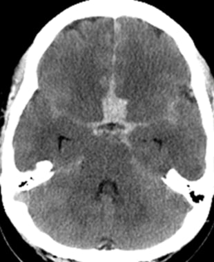 Subarachnoid hemorrhage  Radiology Reference Article