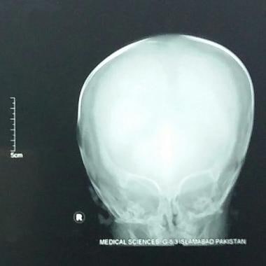 Antero-posterior view on skull radiograph of a 1-y
