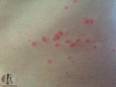 Sea Lice Are Showing Up At Some Florida Beaches, And Yes, They Sting