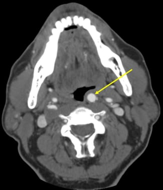 Axial CT scan with contrast demonstrating a left a