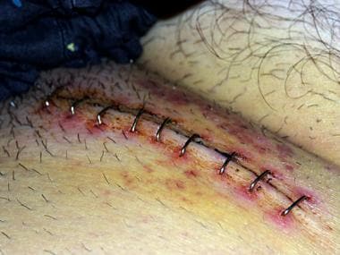 Surgical staples in groin after inguinal hernia op