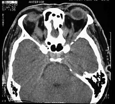 轴向计算机断层扫描(CT) 1例