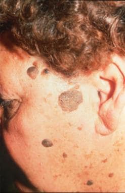 nodule skin lesion