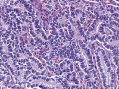 This Sertoli cell tumor shows closely packed hollo