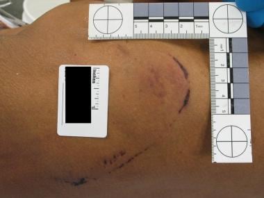 Forensic Autopsy of Blunt Force Trauma. Patterned 