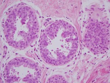 intraductal papilloma with usual ductal hyperplasia