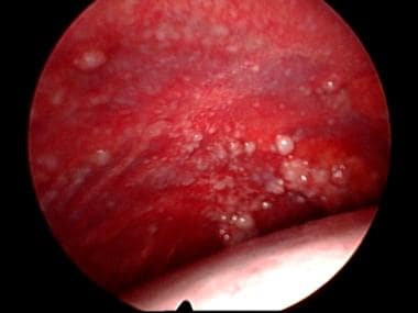 Examination for evidence of metastasis. 