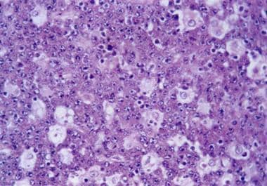 Burkitt lymphoma. Normal architecture is entirely 