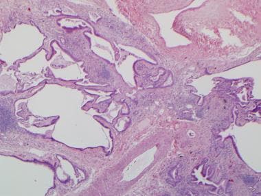 interstitial lung disease histology