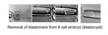Removal of blastomere from an 8-cell embryo (cleav