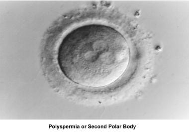 Infertility. Polyspermia or second polar body. Ima