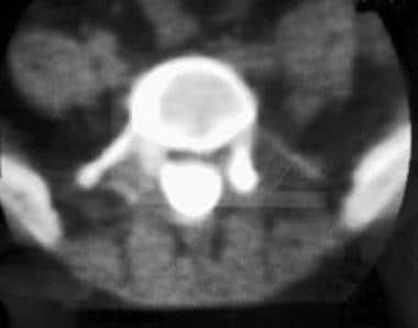 Postoperative CT myelogram obtained at the level o