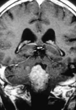 Case 2b. Fourth ventricle ependymoma. T1-weighted 