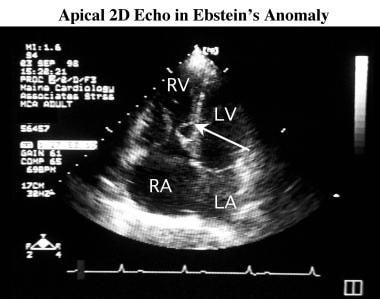 Apical 4-chamber, 2-dimensional echocardiogram in 