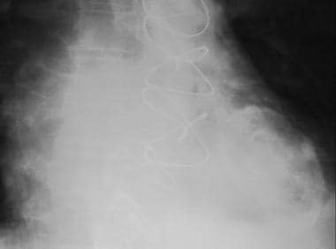 Calcification in a left ventricular aneurysm in a 