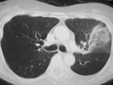Image in a 49-year-old patient with pneumococcal p