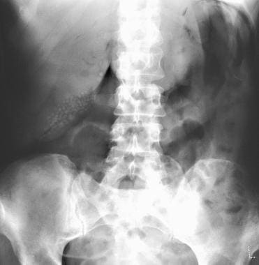 Plain abdominal radiograph of a 68-year-old woman 