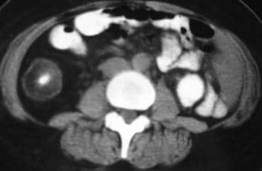 Crohn disease. CT with MRI correlation. CT scan in