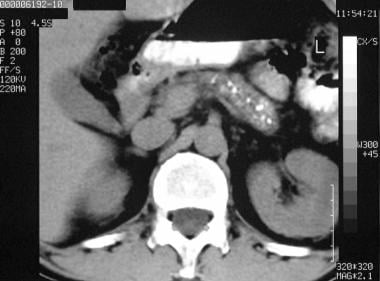 Chronic pancreatitis. Nonenhanced axial CT scan th