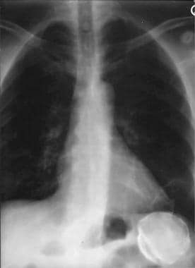 Spleen, trauma. Chest radiograph shows a periphera