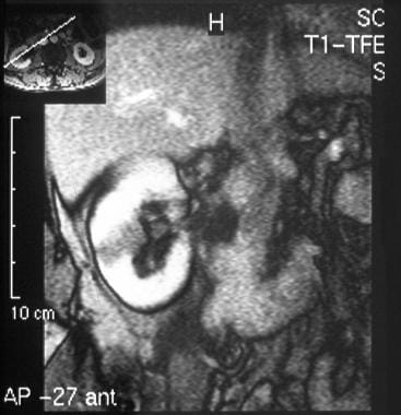 von Hippel-Lindau syndrome. Oblique coronal T1-wei
