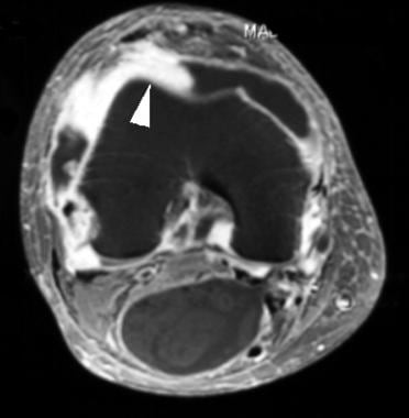 Axial, T1-weighted magnetic resonance image of the