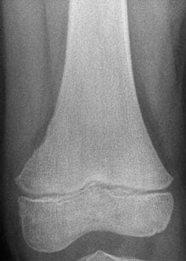 Anteroposterior image of the distal femur in an 8-