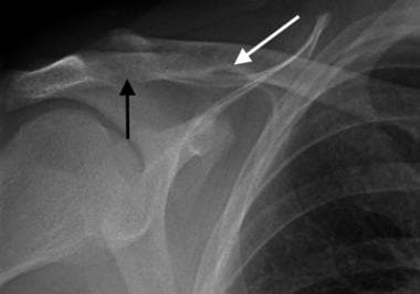Anteroposterior radiograph of the shoulder in a pa