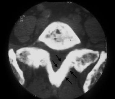 CT image of the first sacral vertebra demonstrates