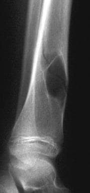 A 9-year-old girl with a simple bone cyst in the d