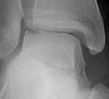 Stage 4 osteochondral fracture of the talar dome, 