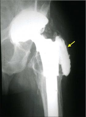 Image from a patient who had a cemented total hip 