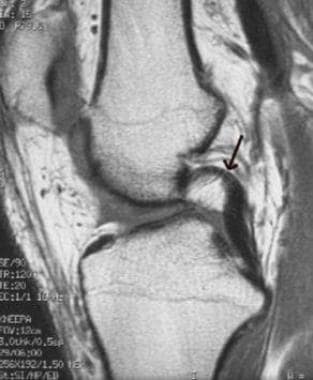 Posterior cruciate ligament (PCL) redundancy as a 