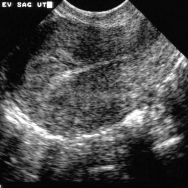 Sagittal endovaginal sonogram of the uterus. This 