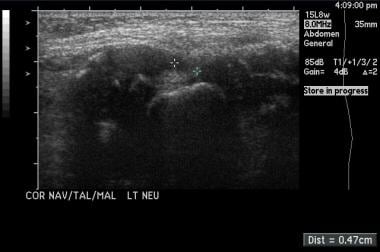 Medial ultrasonogram shows a clubfoot in the neutr