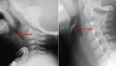 Plain lateral film of the neck showing soft tissue swelling and gas